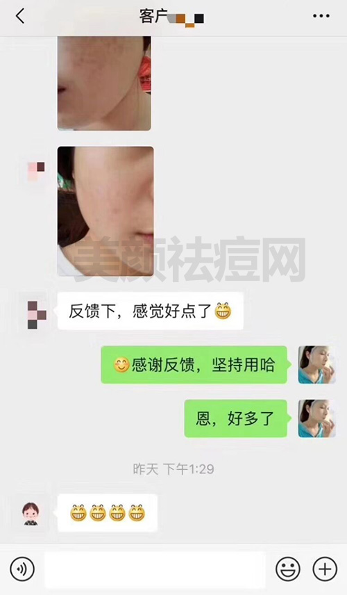 痘印案例：怎么消痘印的真实案例分享