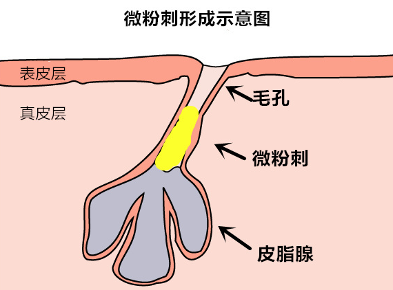 脸上长闭合性粉刺一般都是什么原因