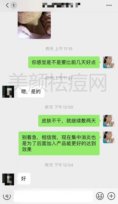 快速祛痘看这位痘友反馈