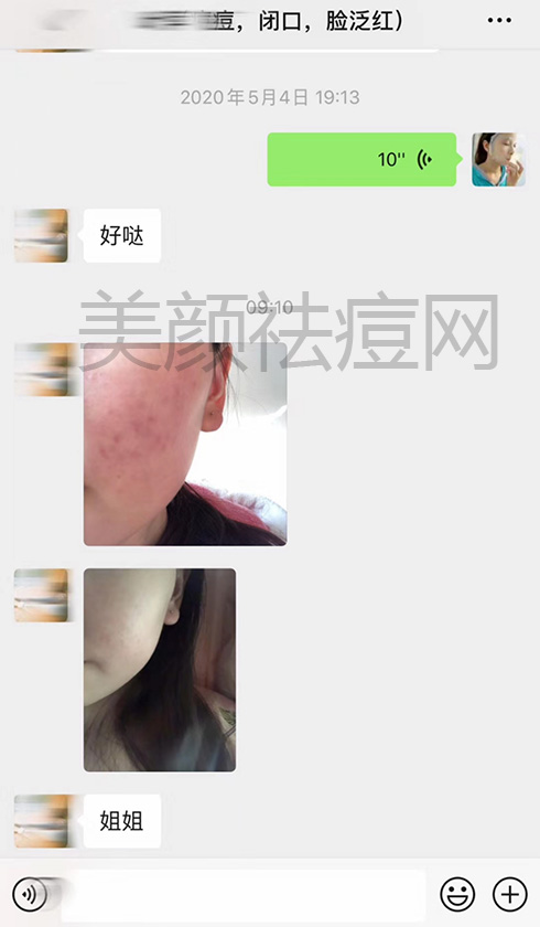 长痘痘脸红发热过敏调理案例