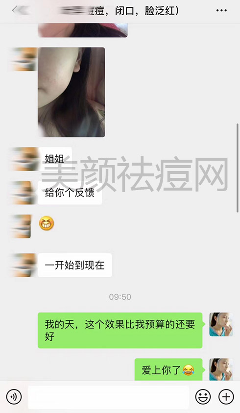 长痘痘脸红调理案例2