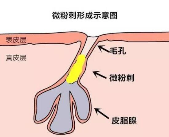 闭口是在毛囊内形成的