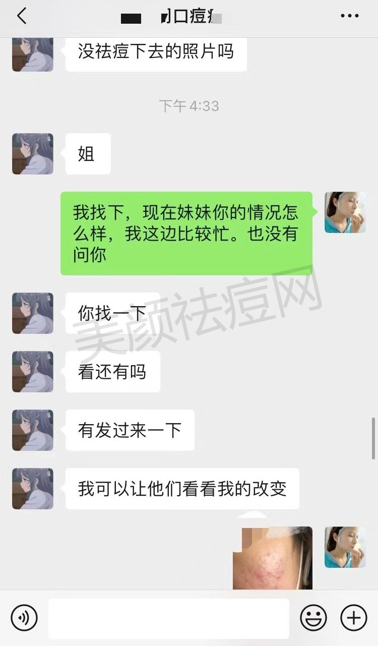 脸上不停的长粉刺痘痘怎么根治去除分享2