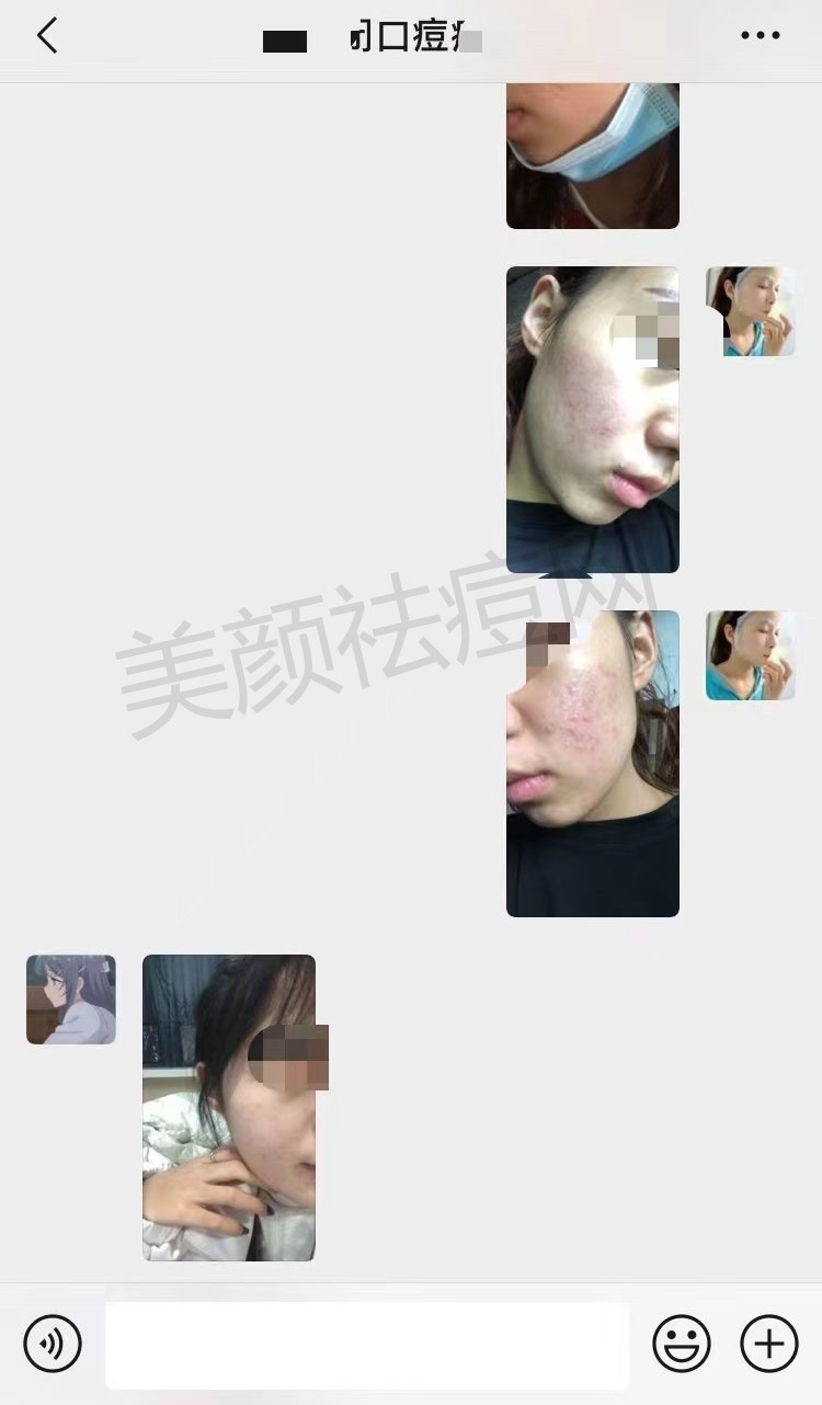 脸上不停的长粉刺痘痘怎么根治去除分享3